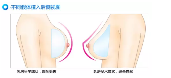 最新隆胸技术论述,探索2024年隆胸新方法