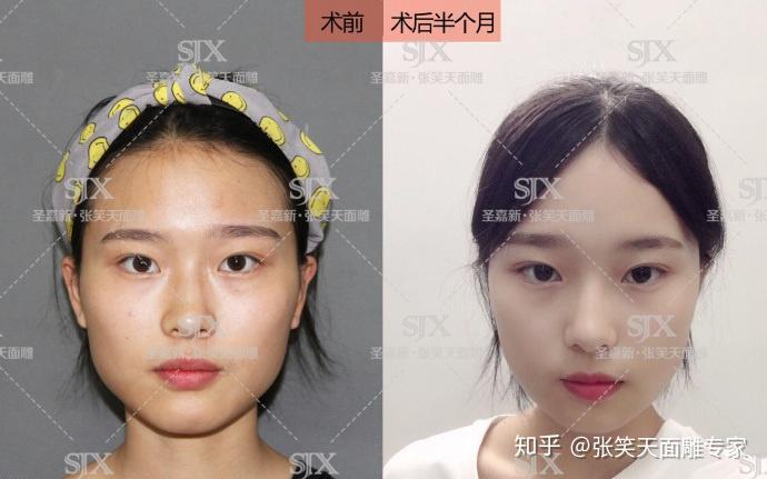 最新削骨技术及其步骤指南