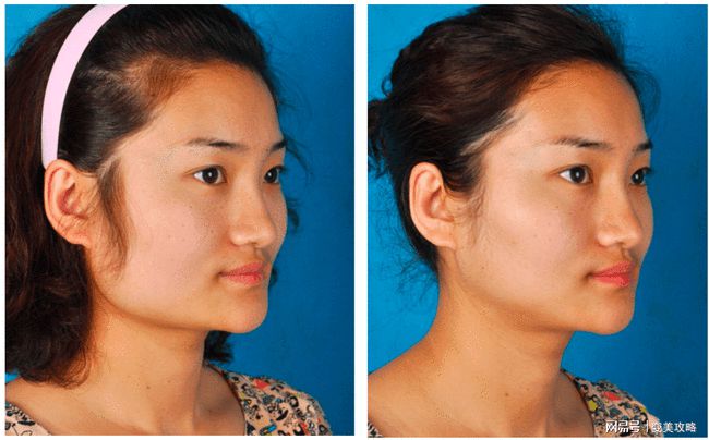 最新削骨技术及其步骤指南