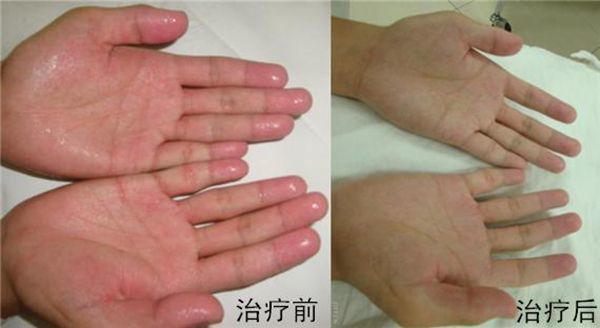手汗症最新治疗技术的观点论述与进展