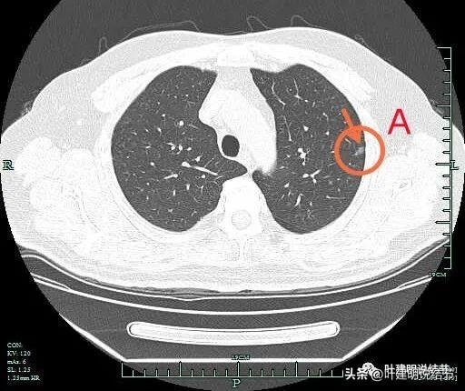 做骨水泥手术的价格表与详细步骤指南