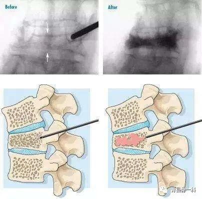 做骨水泥手术的价格表与详细步骤指南