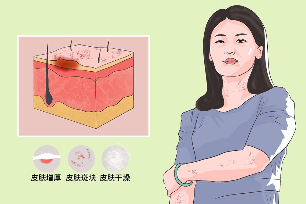 硬皮病治疗最新进展研究揭秘