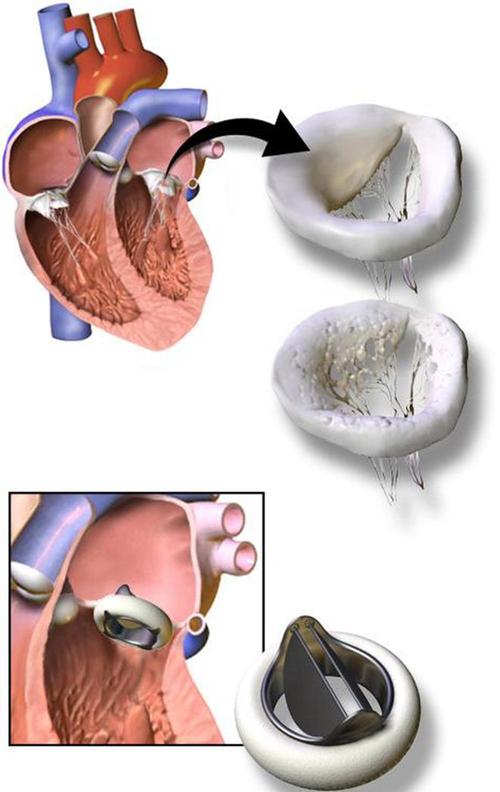 最新心脏瓣膜技术，重塑心脏健康，重燃生命之光