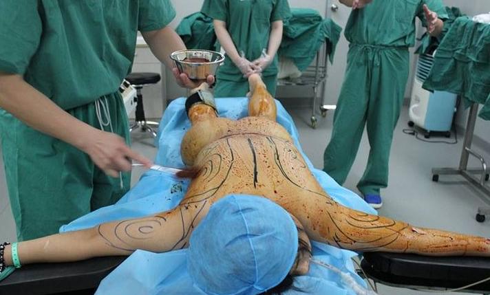 抽脂减肥价格大全，最新抽脂减肥价格一览表