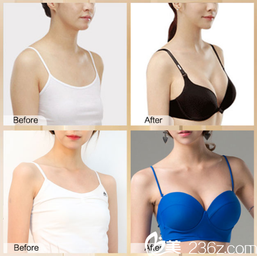 丰胸价格揭秘，历史背景与现代洞察