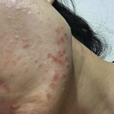 青春痘印，记录友情与时光的痕迹